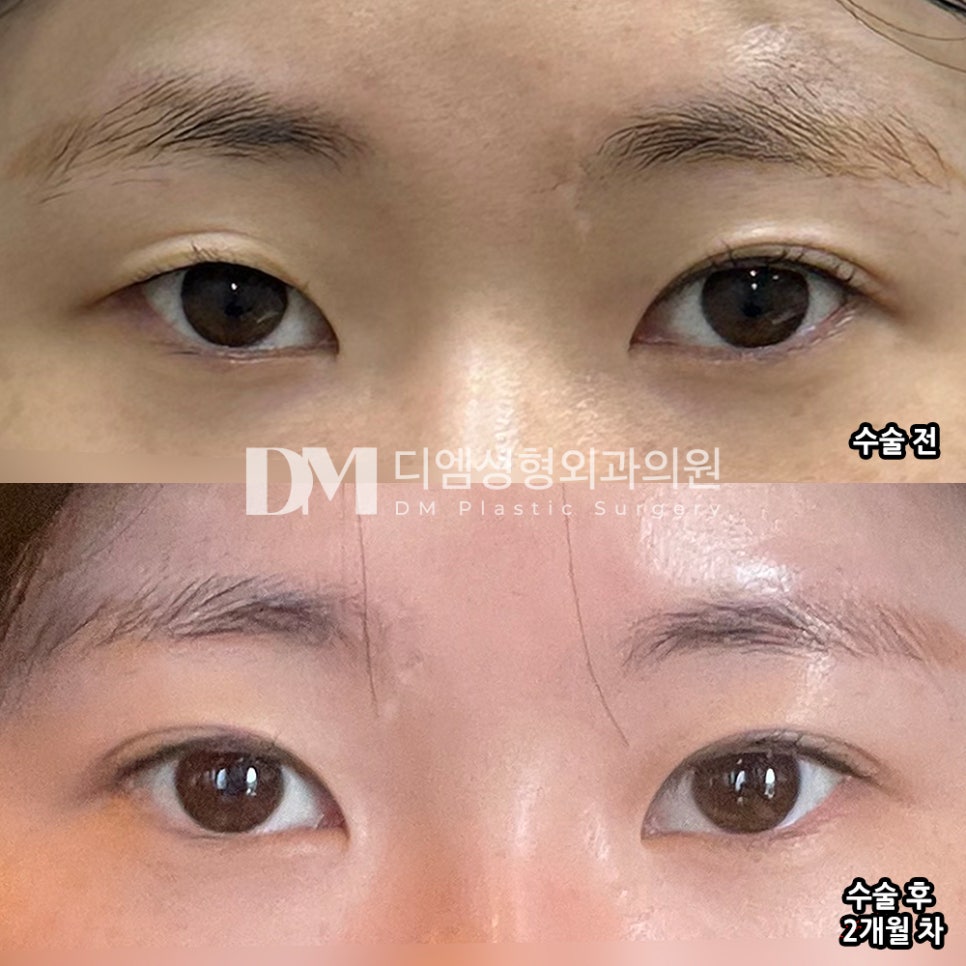 DM Revision Eyelid Surgery/Eye Shape Correction Review, &ldquo;The correction turned out so well, and my eyes look more defined!&rdquo; image 2