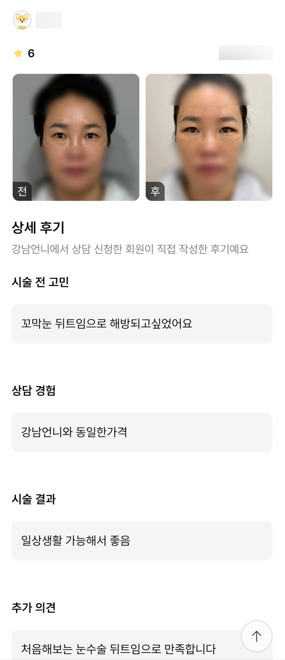 Back Canthoplasty Review. “My First Eye Surgery, and I’m Satisfied with the Back Canthoplasty” image 1