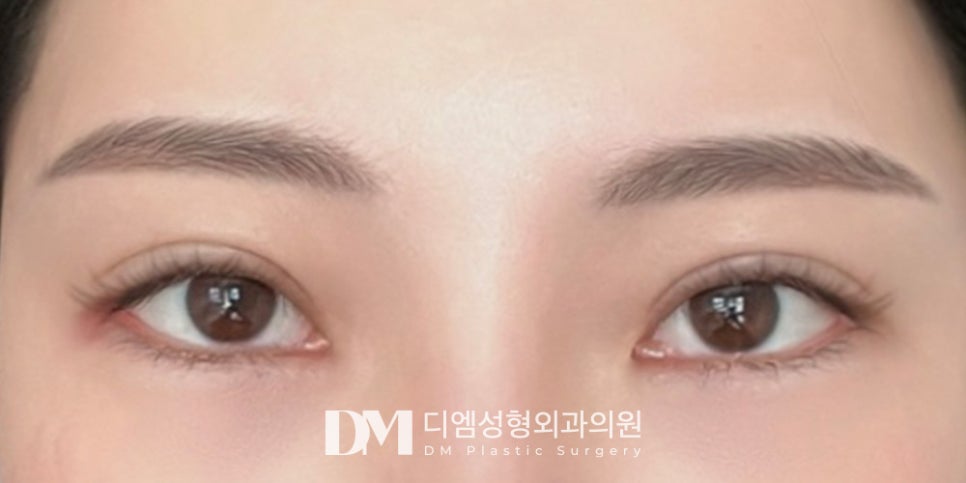 Revision Eyelid Surgery: Identifying the Cause of Failure Is Most Important! image 9