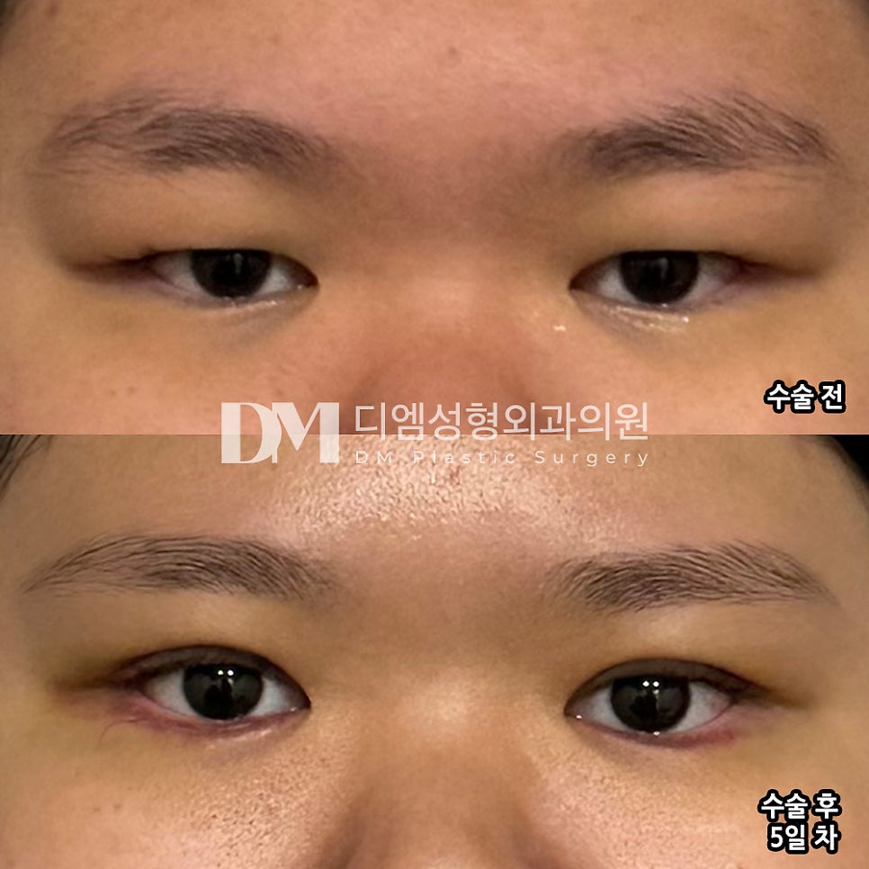 Eyelid Surgery Review. "I’m glad the results showed up faster than I expected!" image 2