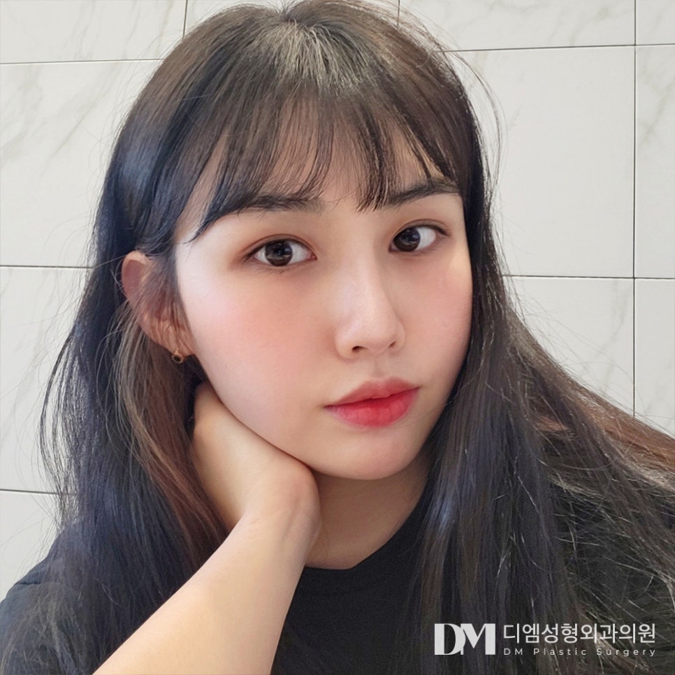 눈매교정, 겹주름 진 눈두덩이로 피곤해 보인다면? 관련 이미지 1