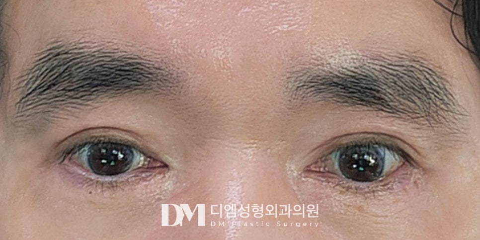 상안검 , 시야확보부터 동안 효과까지 ! 관련 이미지 11