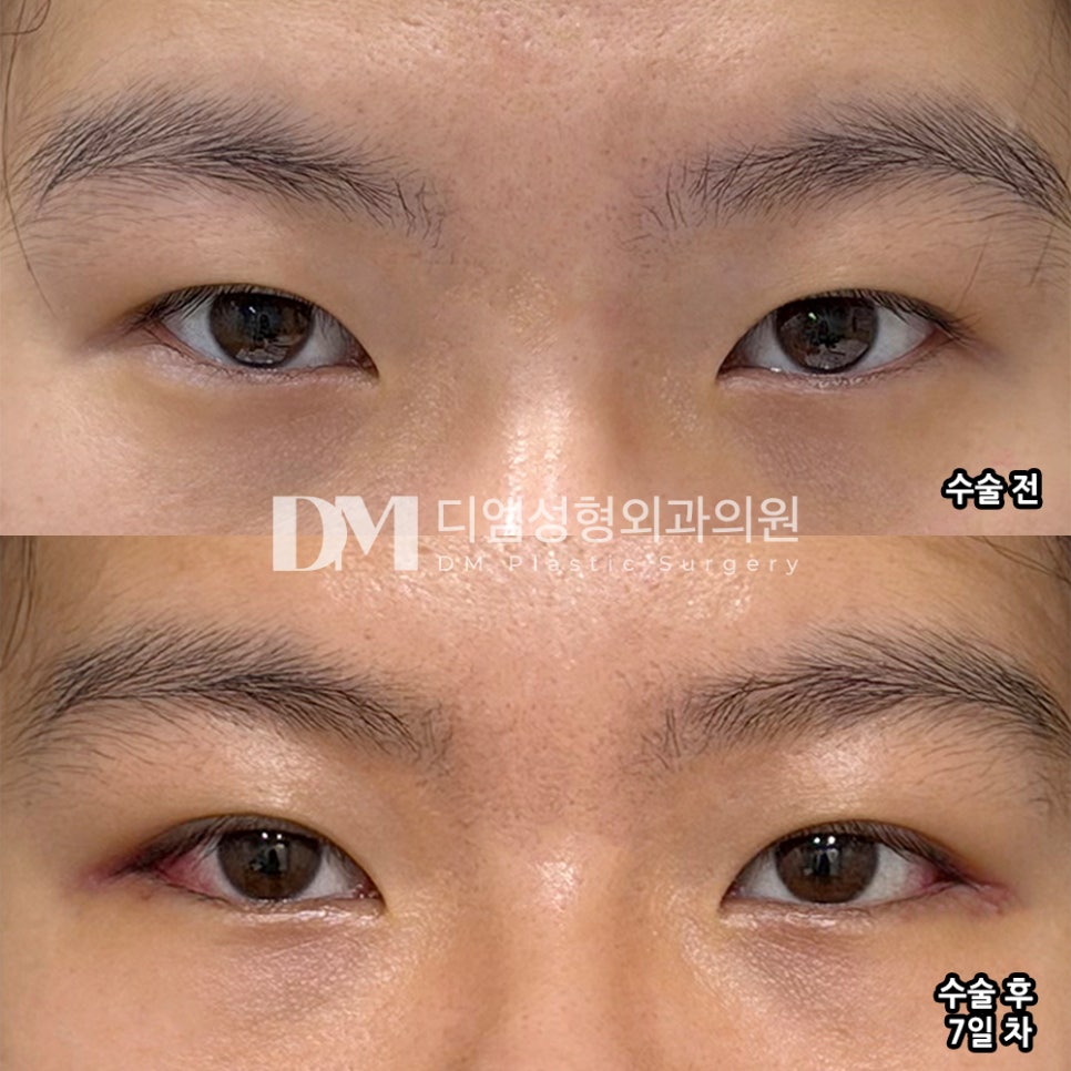 디엠 뒤밑트임 수술후기, “꼬막눈이 확 개선되어서 너무너무 만족해요!” 관련 이미지 2