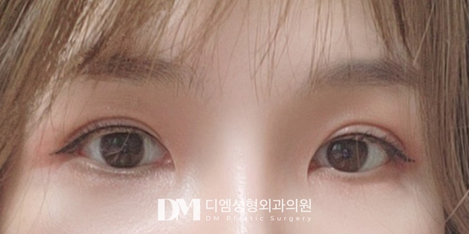처지고 덮힌 눈매가 고민인 중년 모이세요 ! 관련 이미지 10