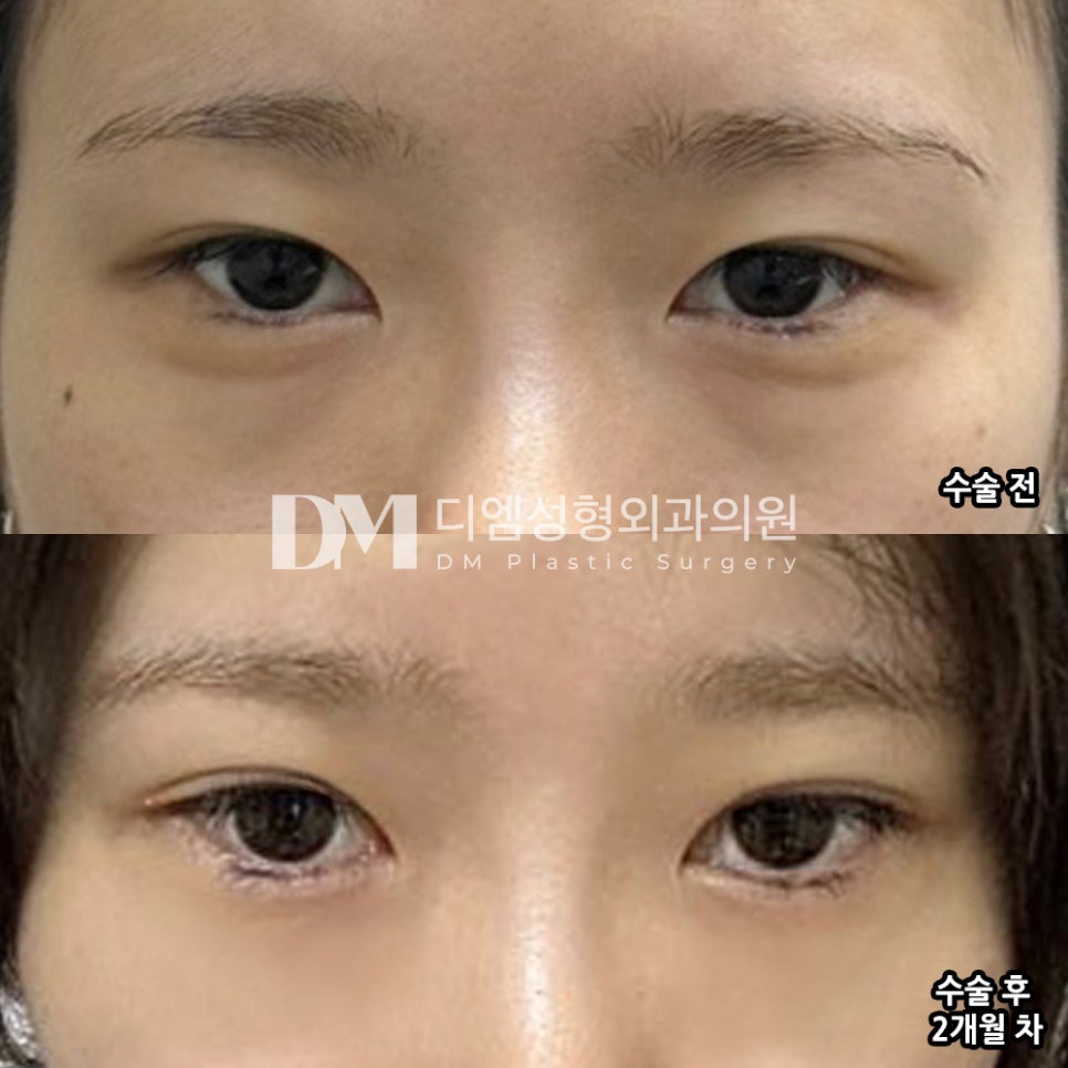 눈재수술 후기."원하는대로 되서 좋아요!" 관련 이미지 2