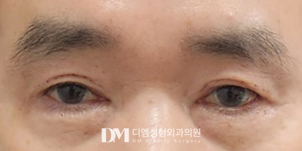 상안검 , 시야확보부터 동안 효과까지 ! 관련 이미지 10