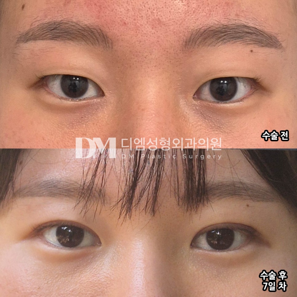 눈성형 후기."예쁜 속쌍이 생기니까 너무 맘에 들어요!" 관련 이미지 2