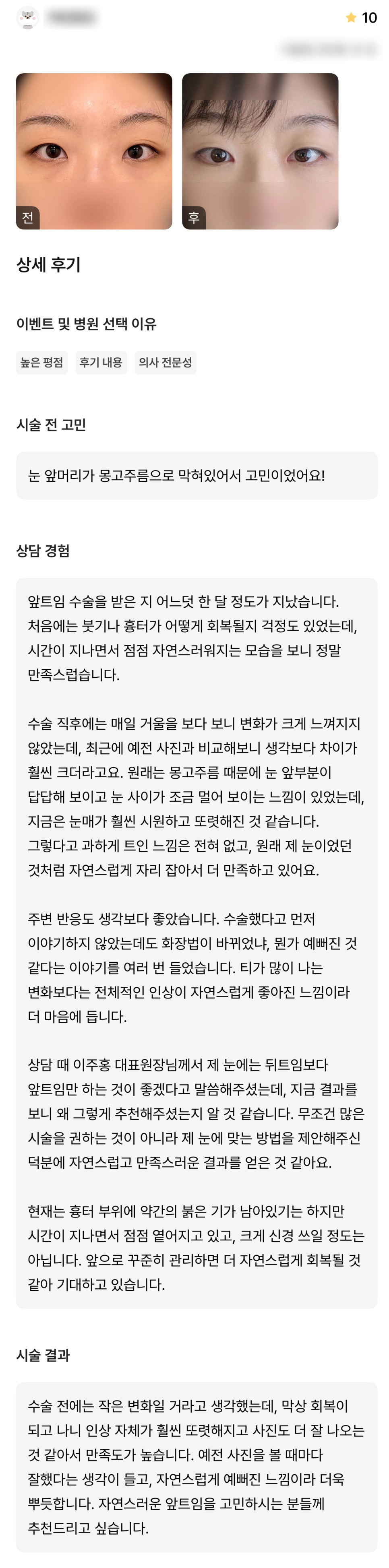 디엠 앞트임 수술후기, “자연스럽게 자리 잡아서 더 만족하고 있어요!” 관련 이미지 1
