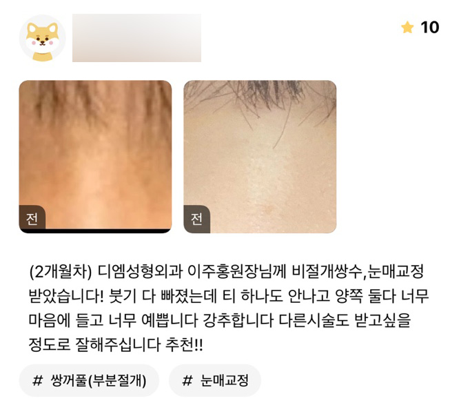눈성형 후기."티 하나도 안나고 너무 마음에 들고 예뻐요!" 관련 이미지 1