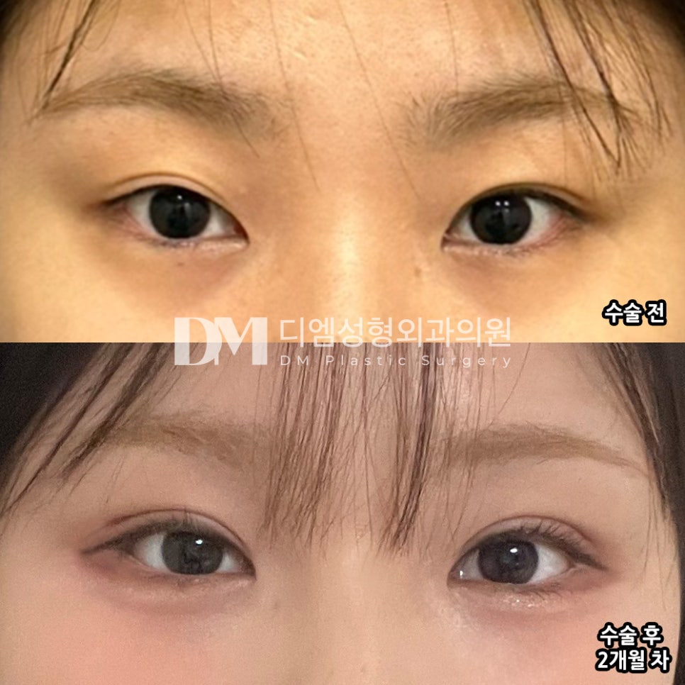 눈성형 후기."주변에서 이쁘다고해서 너무 만족스러워요!" 관련 이미지 2