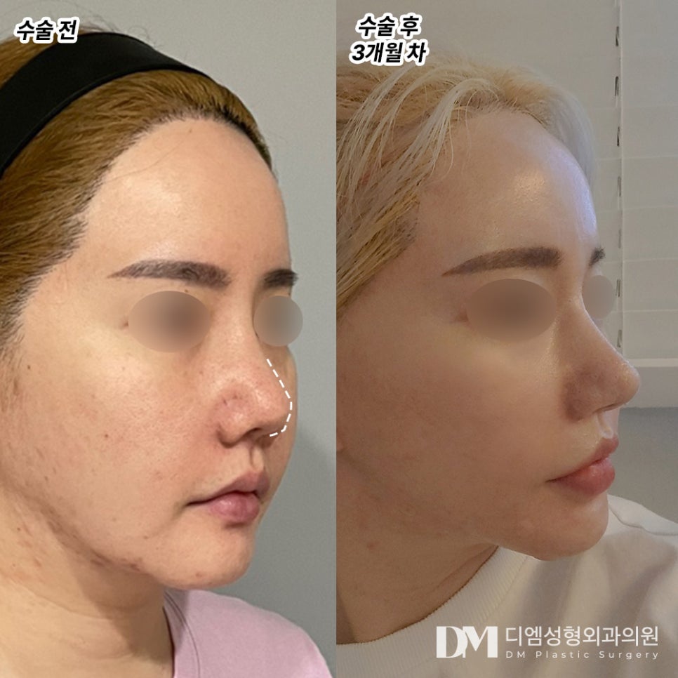 Revision Rhinoplasty: If You're Considering It image 10