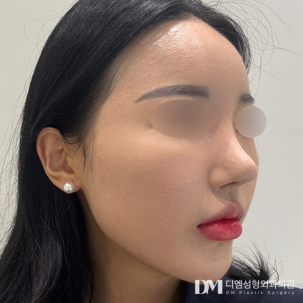 A Flat Facial Contour Transformed into a Three-Dimensional Look with Facial Fat Grafting! image 7