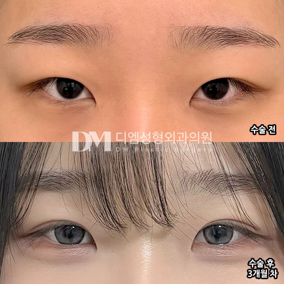 DM Eye-Shape Correction/Double-Eyelid Surgery Review, “I’m satisfied because it doesn’t look too obvious!” image 2