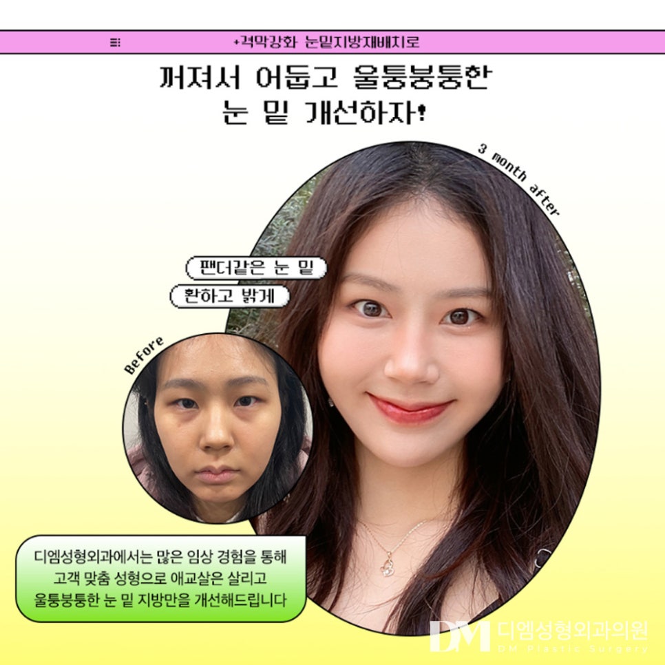 눈밑지방재배치, 불룩해진 눈밑 매끈하게 되살리기! 관련 이미지 2