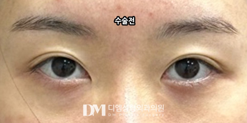 눈매교정 , 힘없는 눈매를 또렷하고 선명하게! 관련 이미지 12