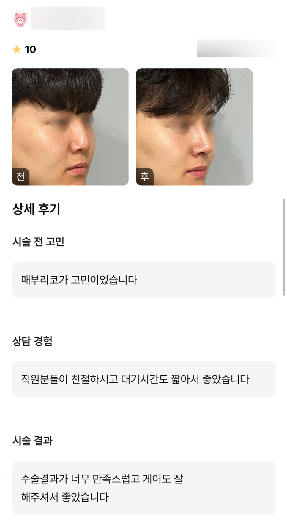 Rhinoplasty Review. "I’m so satisfied with the result!" image 1