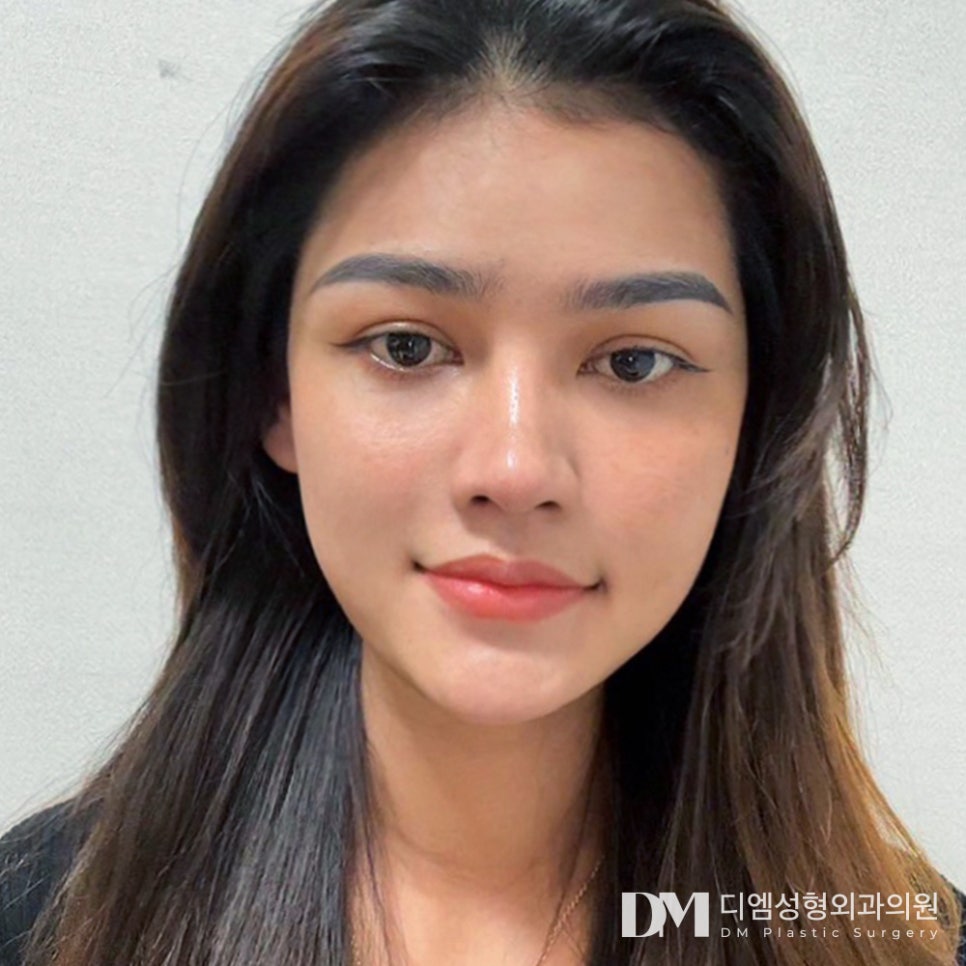 눈밑지방재배치, 피곤한 인상 볼록한 눈밑 개선 효과! 관련 이미지 1