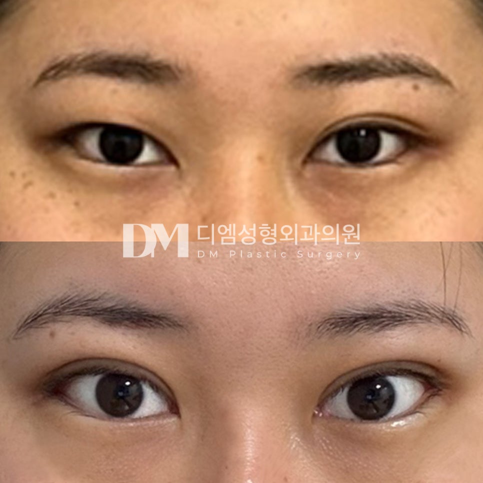 눈성형 후기."라인이 너무 두껍지 않고 자연스럽게 나와서 만족스러워요" 관련 이미지 2