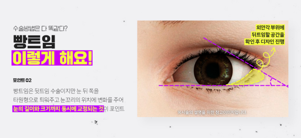 Bbangtwin: Back corner and lower corner eye surgery at the same time! image 3