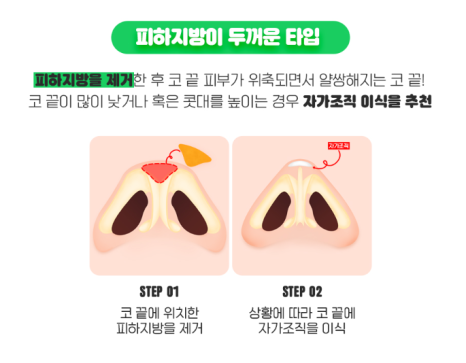 복코성형, 둔해보이는 인상에서 세련된 인상으로! 관련 이미지 8