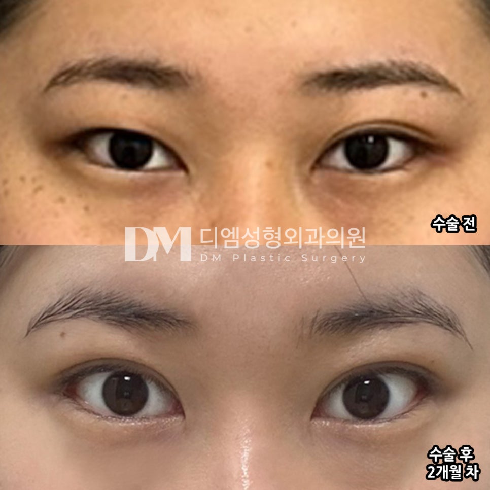 눈성형 후기."너무 만족해요 !!" 관련 이미지 2