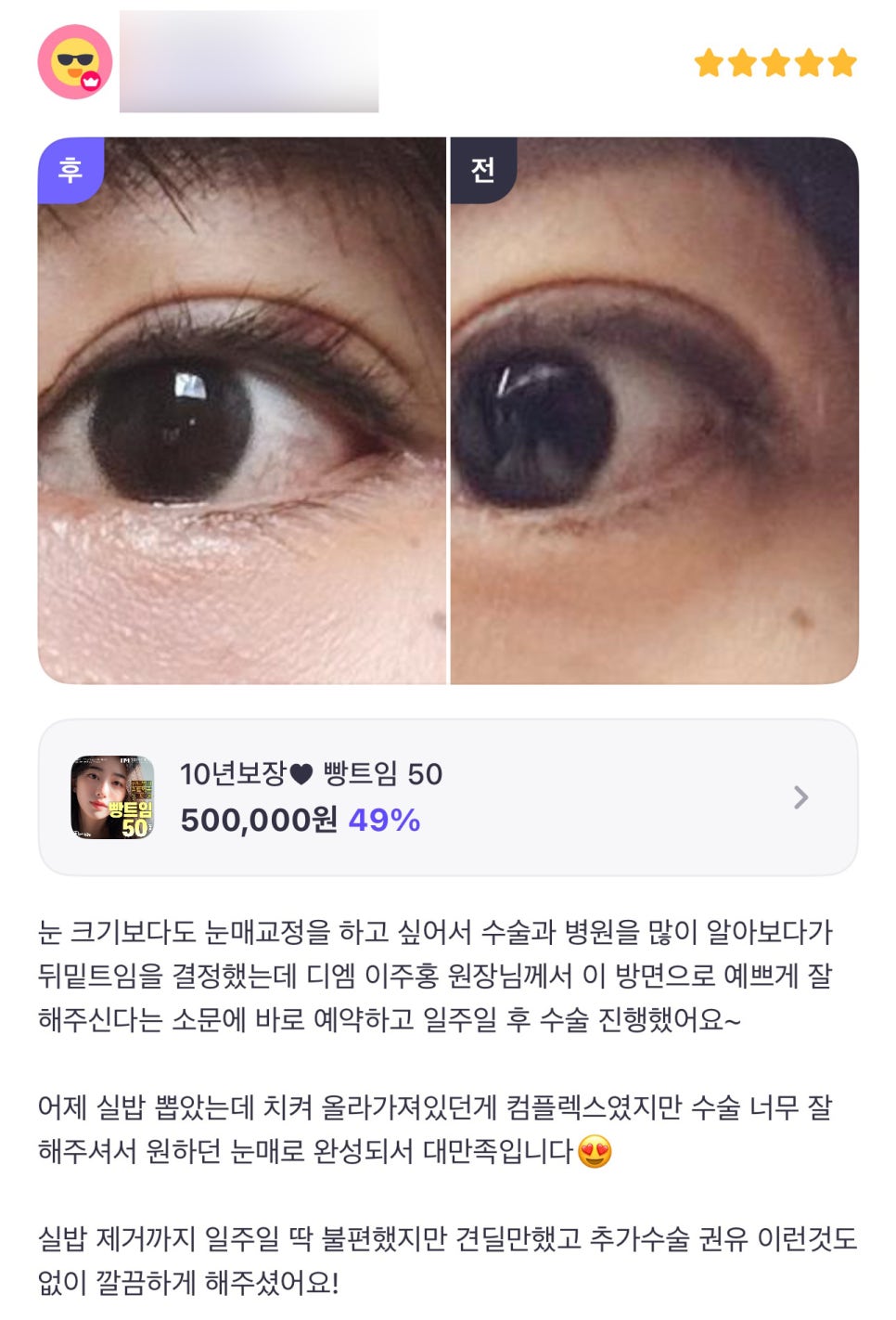 빵트임 후기."올라간 눈매가 컴플렉스였지만 원하던 눈매로 개선되어 좋아요!" 관련 이미지 1