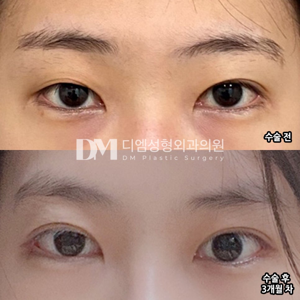 Revision Eyelid Surgery: A Natural Line That Suits My Eyes image 6