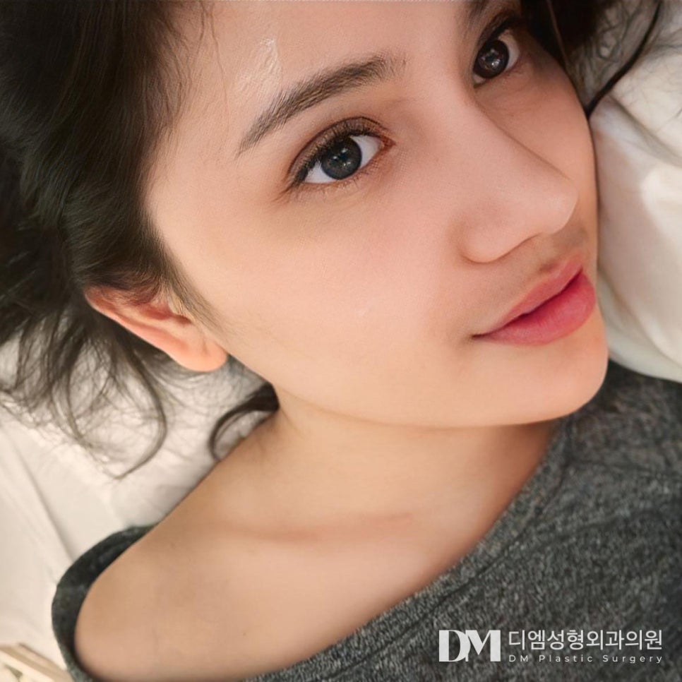 피곤하고 졸려보이는 눈 , 눈매교정으로 개선 가능할까? 관련 이미지 15