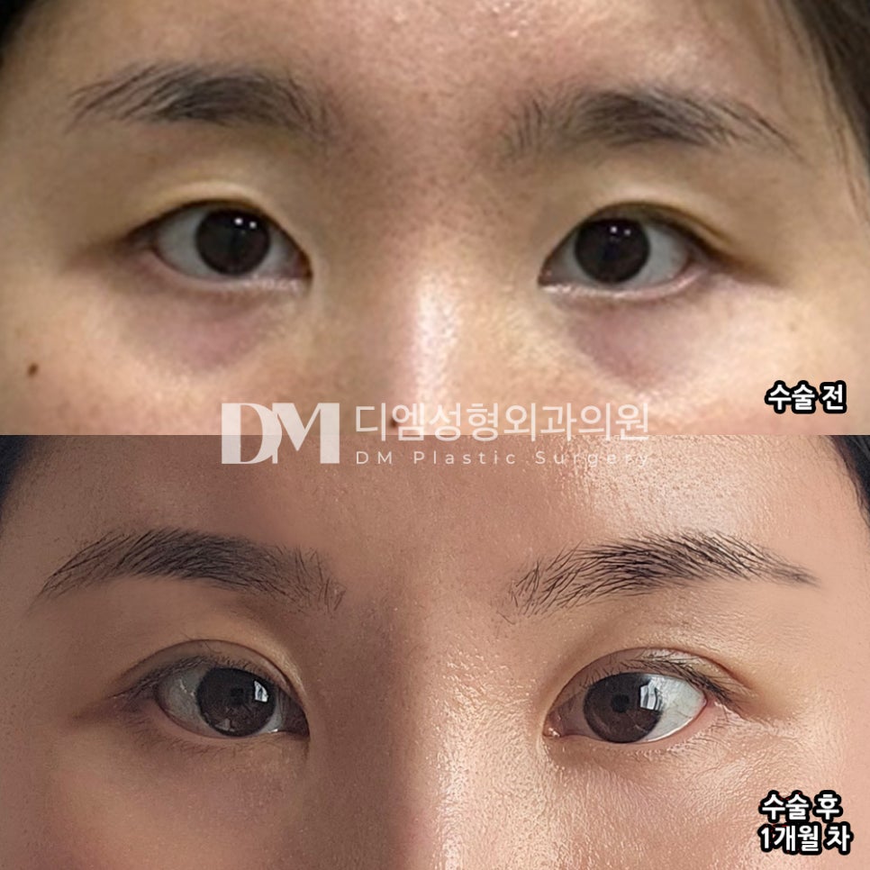 눈재수술 후기."현재 쌍꺼풀 라인이 만족스러워요!" 관련 이미지 2