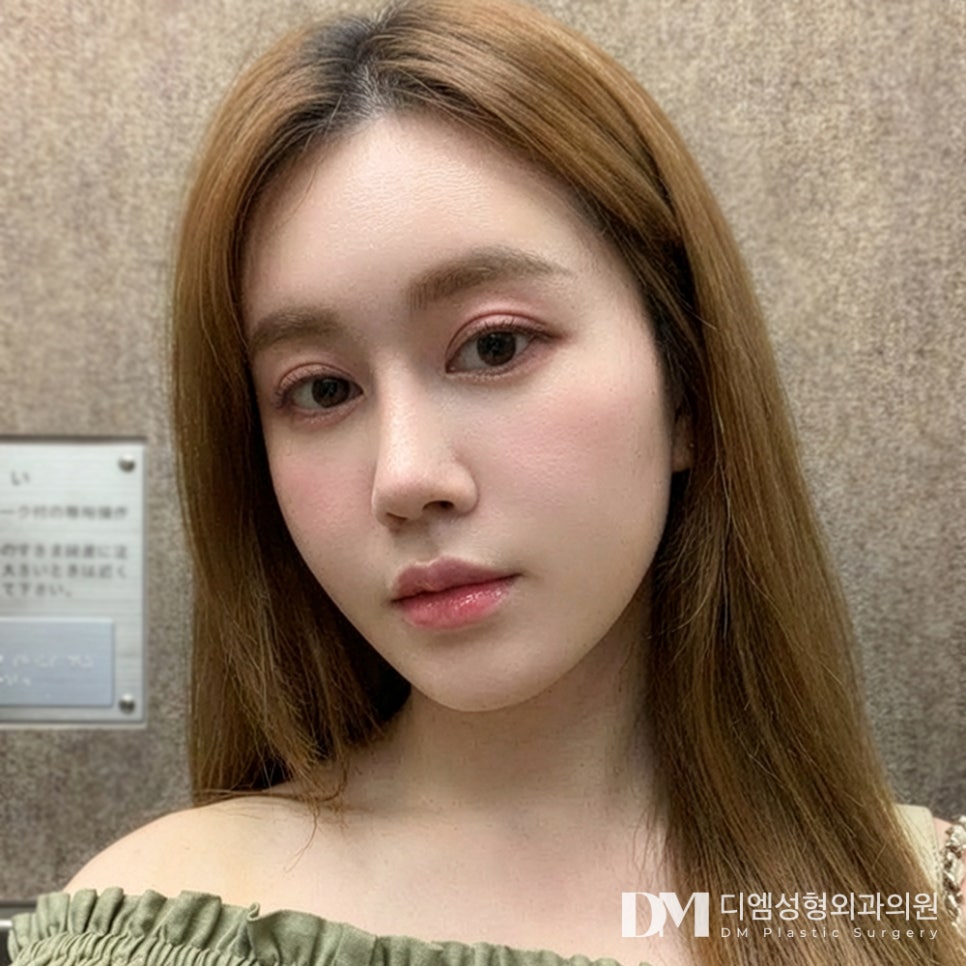 얼굴지방이식 전후사진, 적당히 차오르는 볼륨감 관련 이미지 3