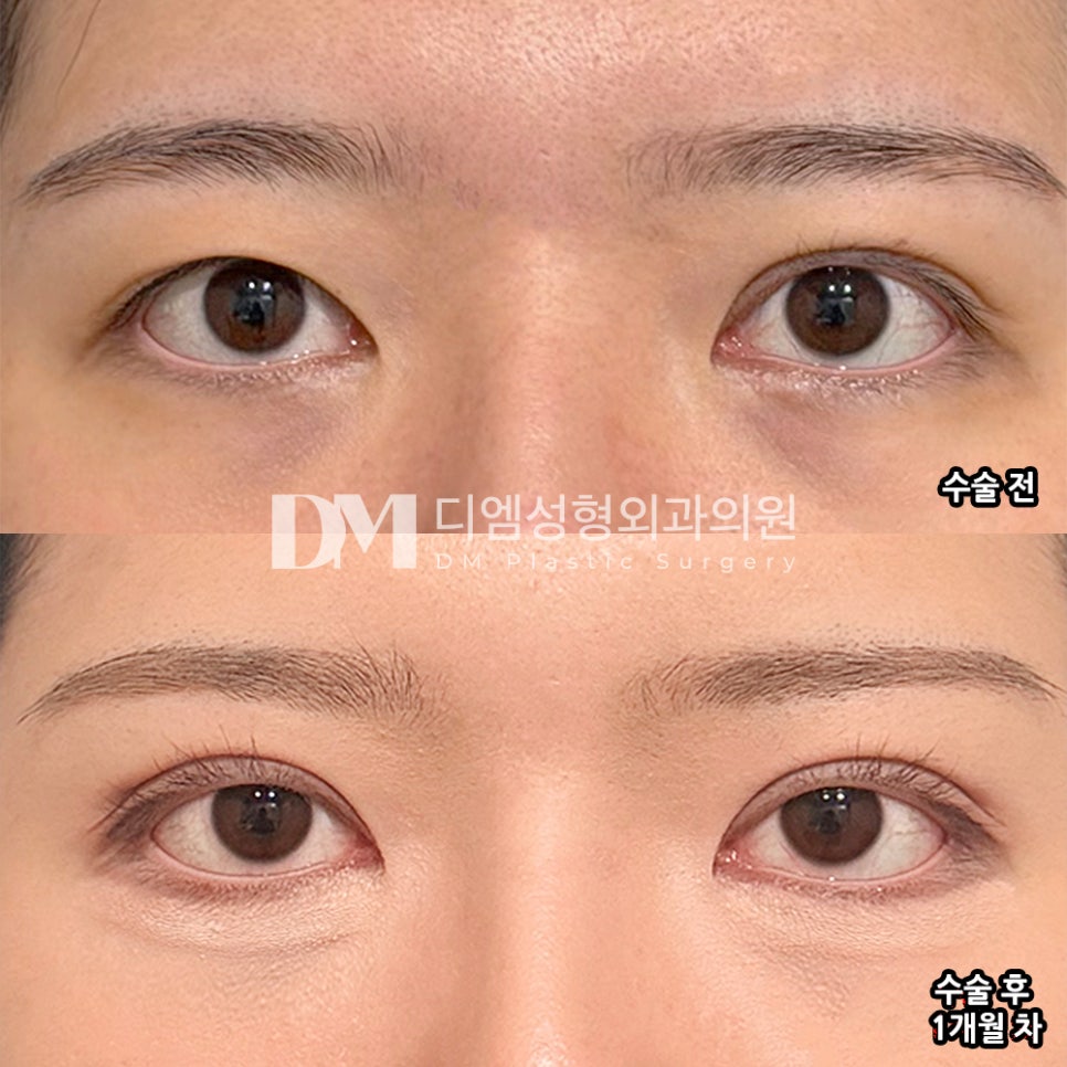 디엠 눈재수술/눈매교정 수술후기, &ldquo;솔직하게 상담해주셔서 믿음이 갔어요!&rdquo; 관련 이미지 2