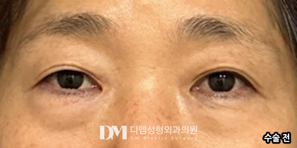 하안검, 눈 밑 노화가 고민이라면? 관련 이미지 7