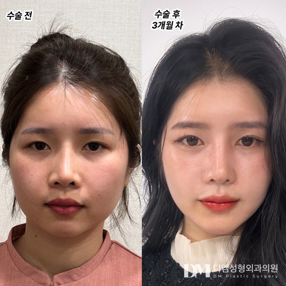 Correcting Sagging Eye Shape with Forehead Lift! image 7