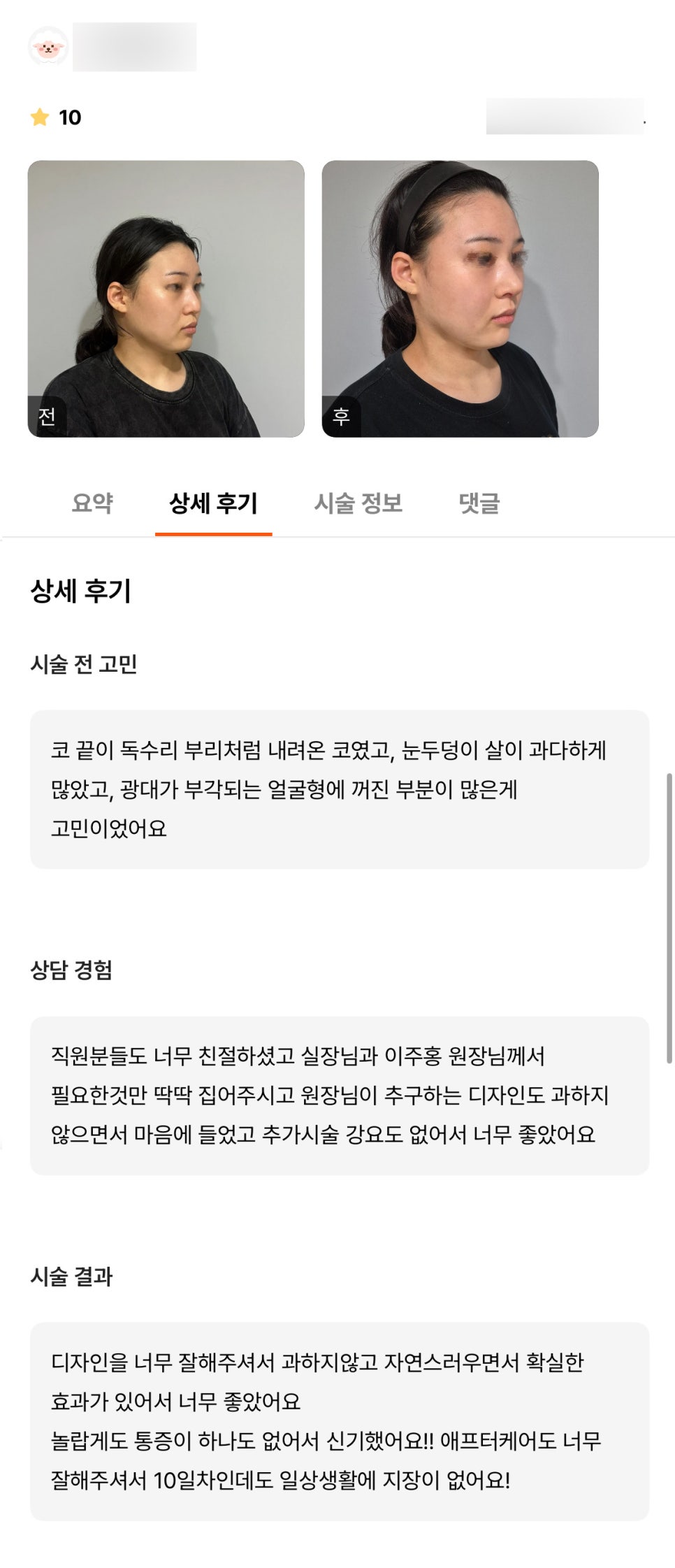 코성형 후기."자연스러우면서 확실한 효과가 있어 너무 좋았어요!" 관련 이미지 1