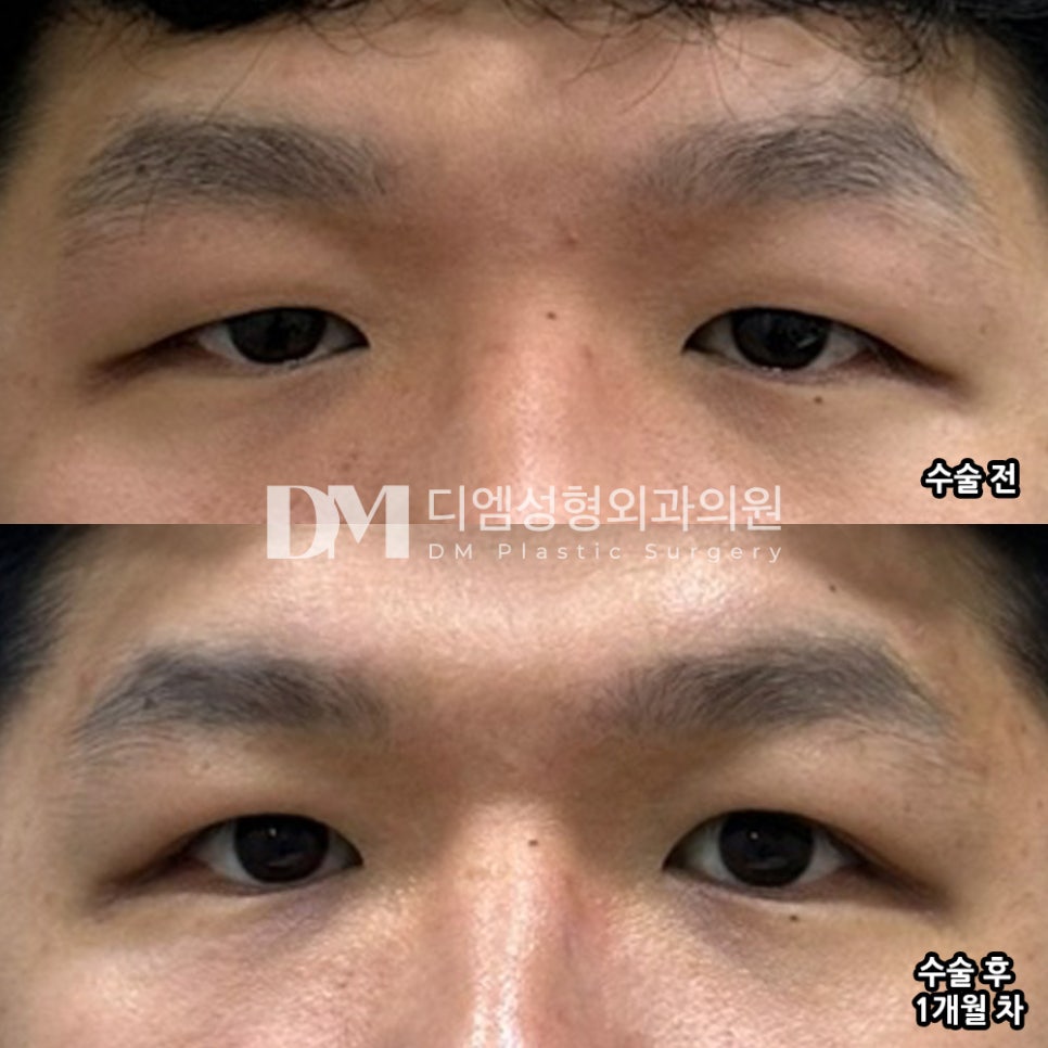 Eye Surgery Review: “Recommended for those who want a natural result without going overboard!” image 2