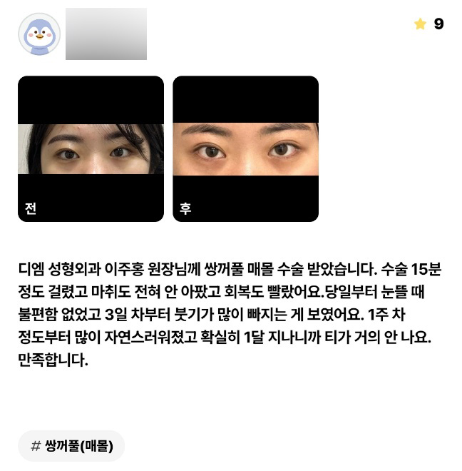 눈성형 후기."자연스럽고 티도 거의 안나서 만족해요!" 관련 이미지 1