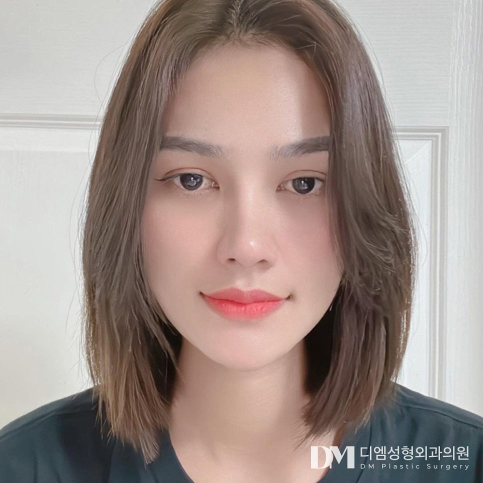 눈밑지방재배치, 불룩해진 눈밑 매끈하게 되살리기! 관련 이미지 1