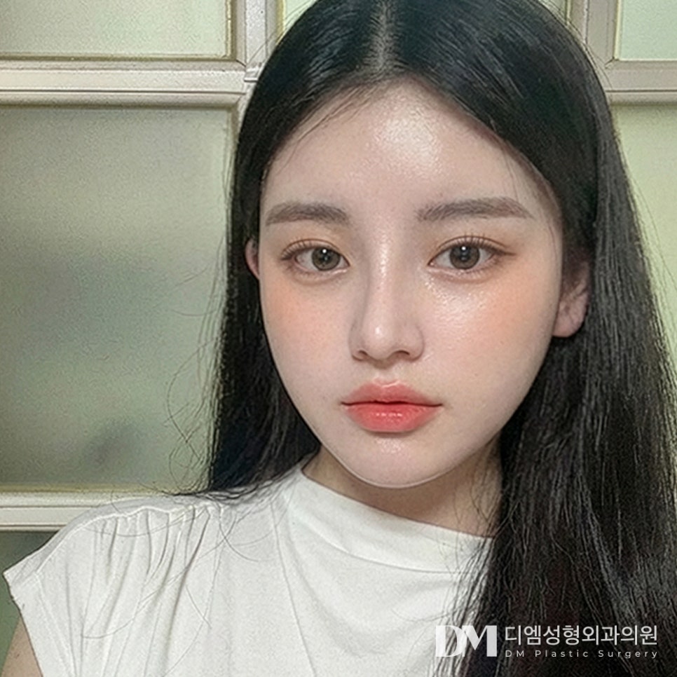 디엠 낮은코성형 전후사진, 입체적인 코 라인의 비결은? 관련 이미지 3
