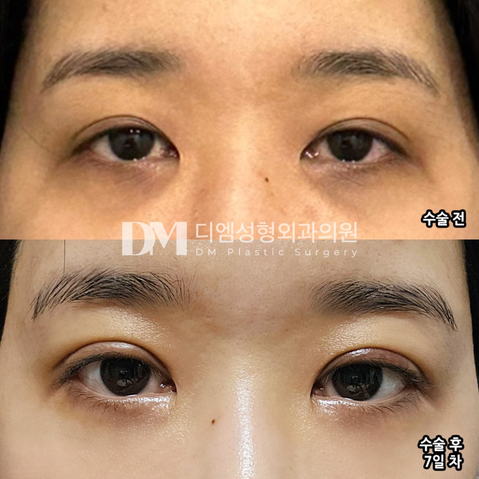 눈재수술 후기."수술 당일부터 멍과 붓기가 훨씬 적어서 만족해요!!" 관련 이미지 2