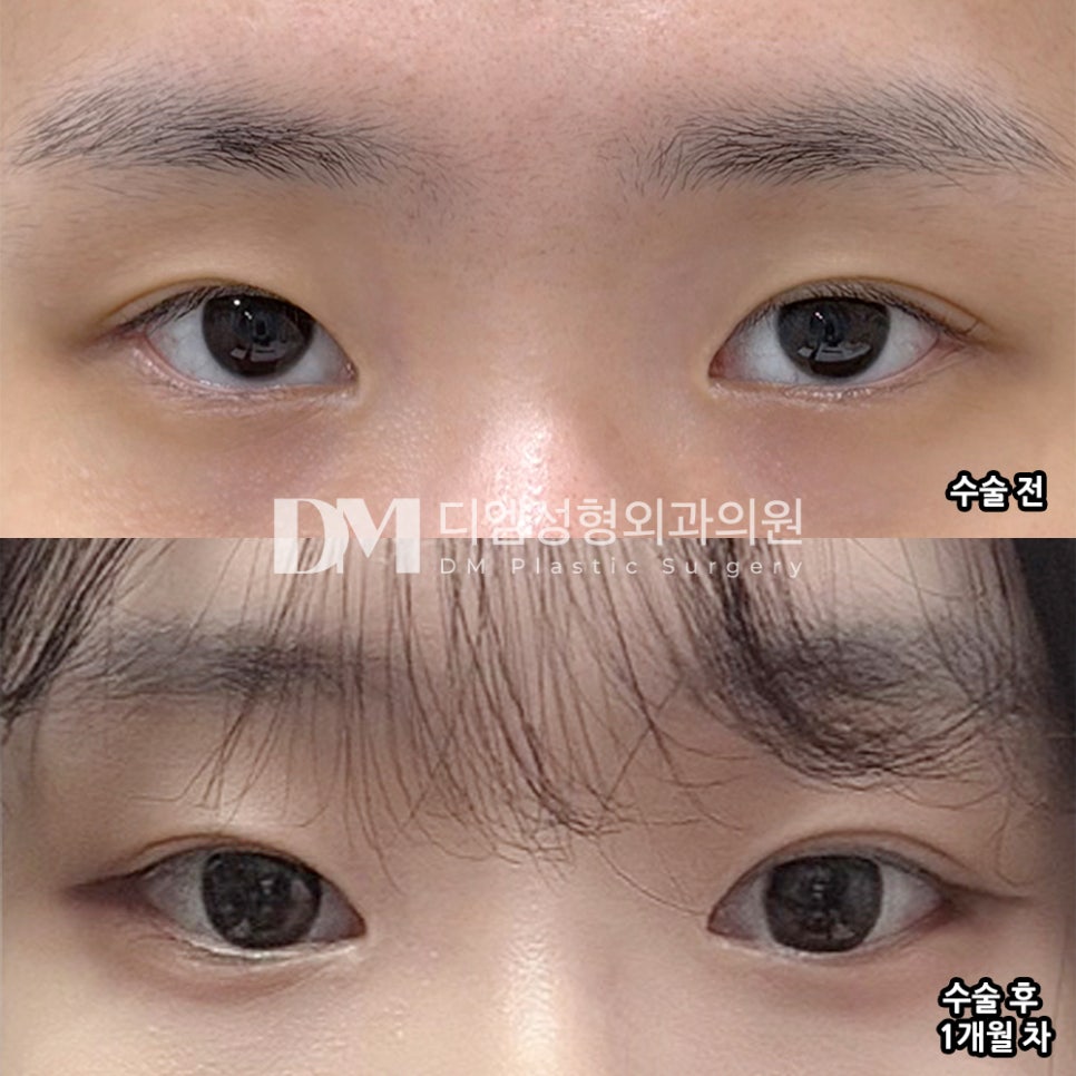 디엠 뒤밑트임/트임성형 후기, “자연스럽게 예뻐진 것 같아서 너무 만족스러워요!” 관련 이미지 2
