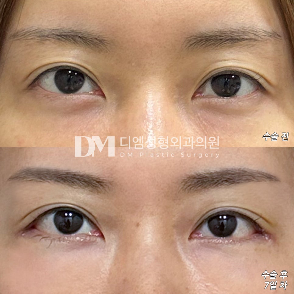 뒤밑트임 후기." 눈 커지고 모양도 맘에 들어 너무 만족합니다 !!!" 관련 이미지 2