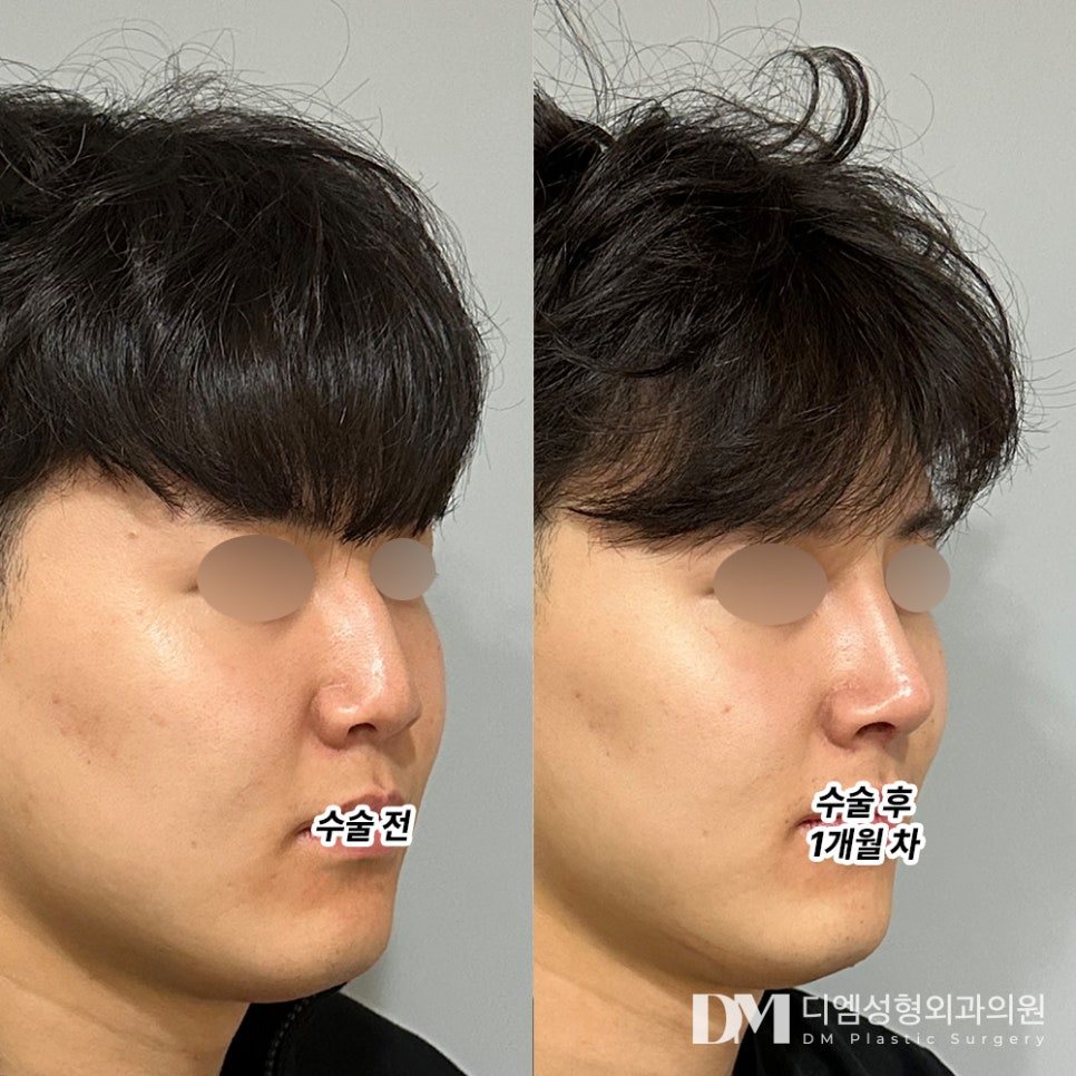 Rhinoplasty Review. "I’m so satisfied with the result!" image 2