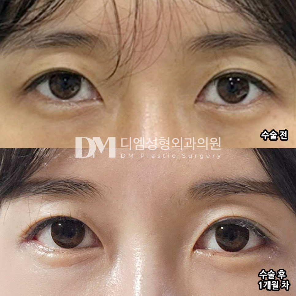 디엠 뒤밑트임 전후사진, 자연스럽게 트인 눈매 가능할까? 관련 이미지 2