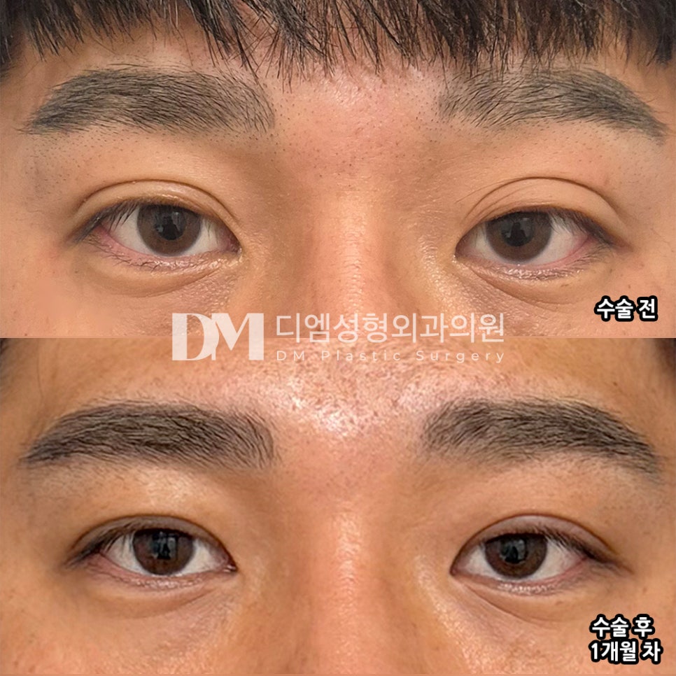 디엠 남자눈성형/남자눈매교정 후기, “수술 결과, 수술 후 케어까지 전부 만족합니다!” 관련 이미지 2