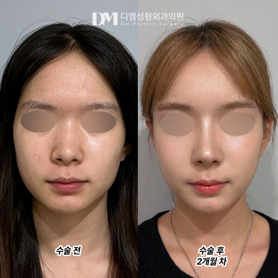 디엠 코성형 후기, “무엇보다 결과에 만족했습니다!” 관련 이미지 2