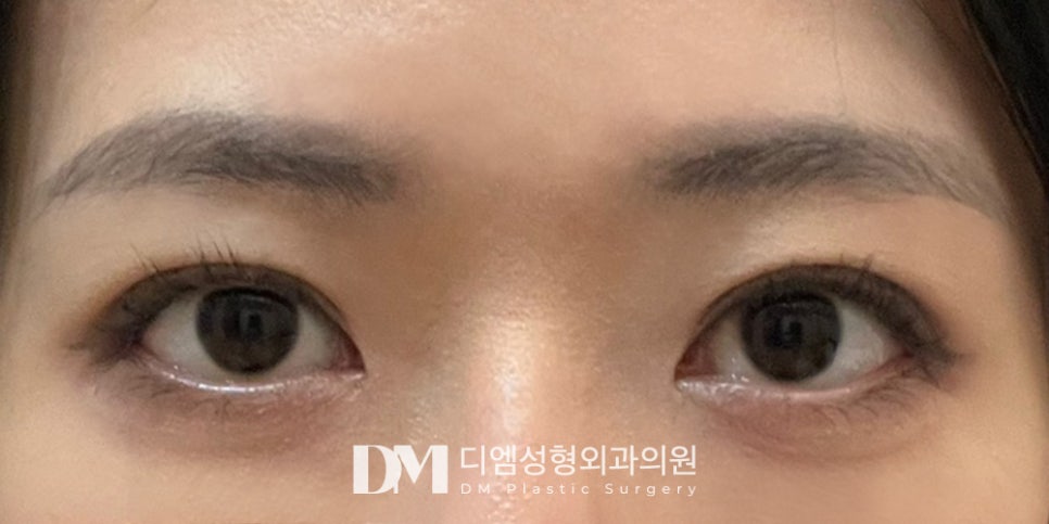 눈재수술, 1:1 정밀검사로 눈성형 실패원인 분석 및 진단은 필수! 관련 이미지 9