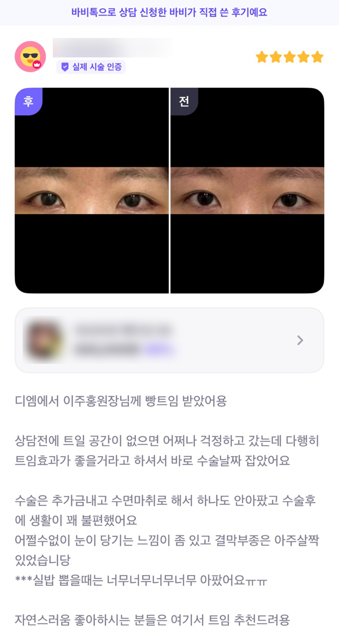 DM Outer-and-Lower Corner Opening Surgery Review, “Recommended for Those Who Like a Natural Look!” image 1