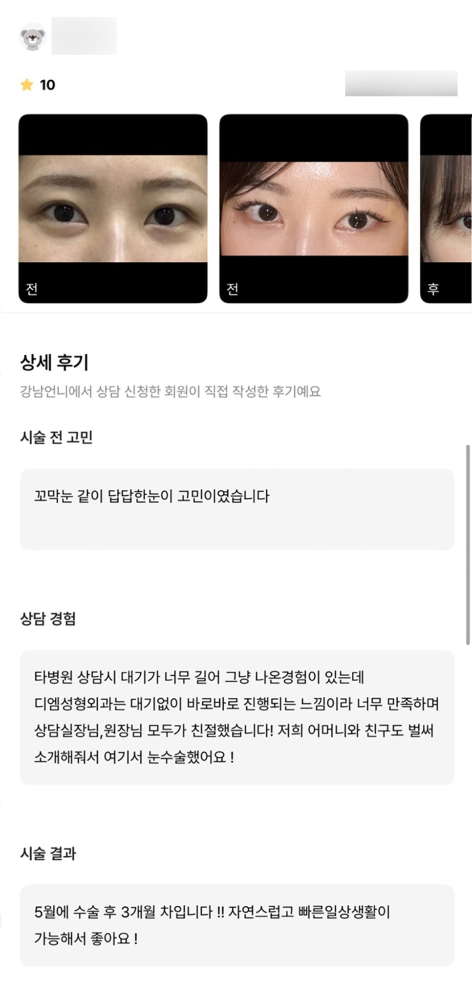 Epicanthoplasty Review. “I like that it allows a natural and quick return to daily life!” image 1