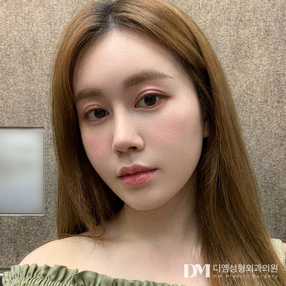 디엠 얼굴지방이식 전후사진, 자연스러운 불륨감과 입체감으로 고민 끝! 관련 이미지 3