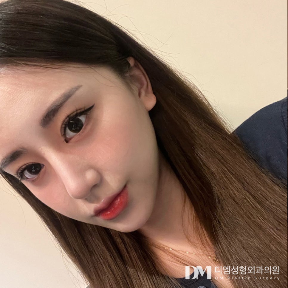 Revision Rhinoplasty: If You're Considering It image 13